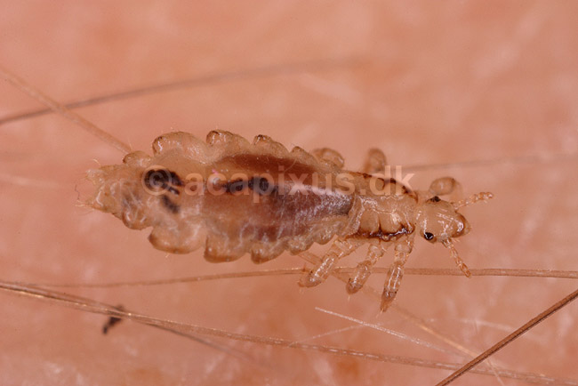 Hovedlus. Hoved lus; Pediculus humanus capitis; ; ; ; insekter; Egentlige lus, Siphunculata, ut�j, skadedyr, h�r, hovedbund, plettyfus